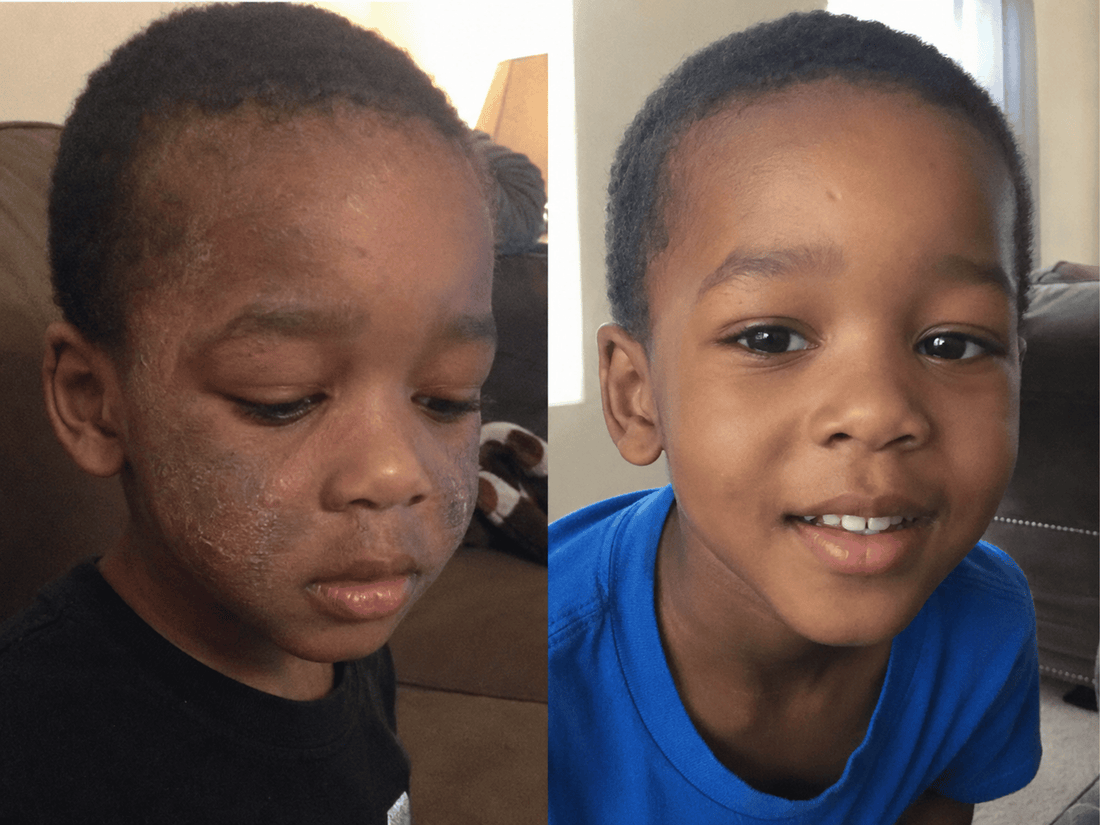 Creams Add Moisture But Your Child's Skin Can't Hold It. Here's The Gap No Cream Can Fill. 5