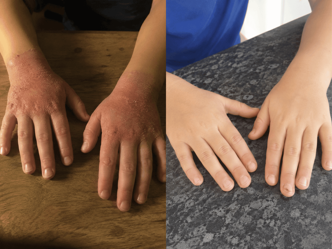 Creams Add Moisture But Your Child's Skin Can't Hold It. Here's The Gap No Cream Can Fill. 3