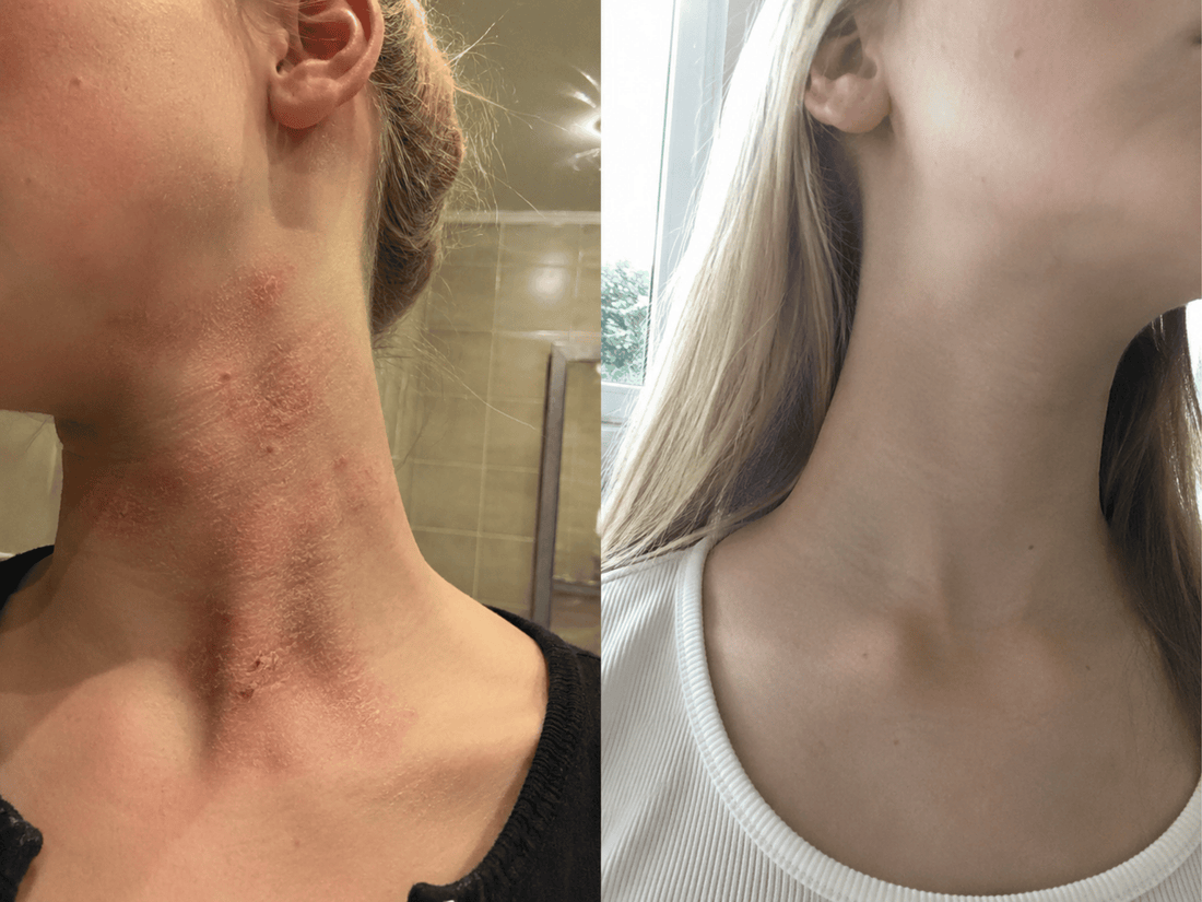 Creams Add Moisture But Your Child's Skin Can't Hold It. Here's The Gap No Cream Can Fill. 4